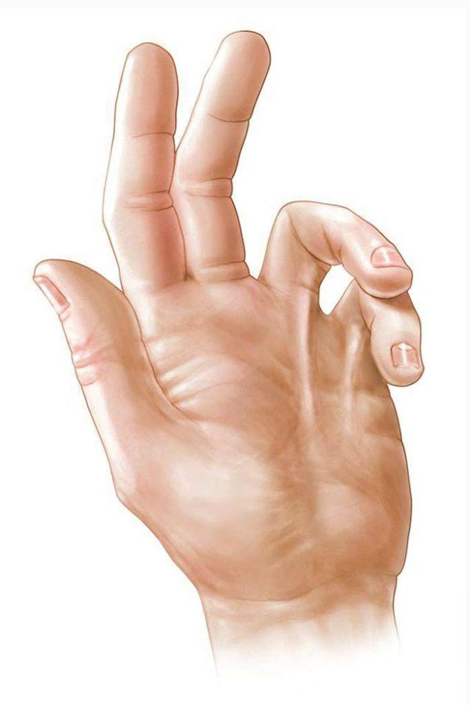 جراحی تریگر پوینت