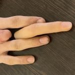 دست انسان با انگشت قطع شده و پروتز سیلیکونی سفارشی در کنار آن