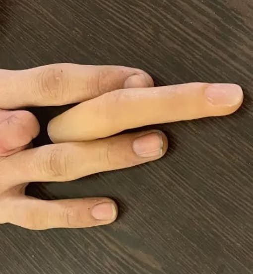 انواع پروتز انگشت دست_پروتز سیلیکونی