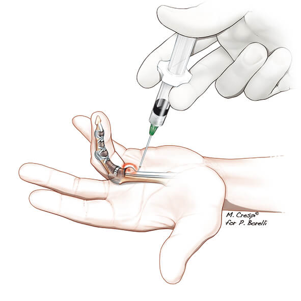تزریق کورتون در تریگر پوینت