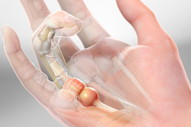 انگشت ماشه ای یا تریگر پوینت