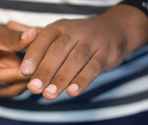 پروتز انگشت دست در تهران – ارتوپد فنی رشد