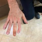 پروتز انگشت دست سیلیکونی با ظاهر طبیعی