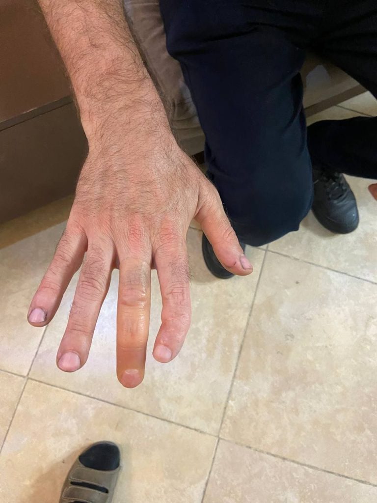 پروتز انگشت دست سیلیکونی با ظاهر طبیعی