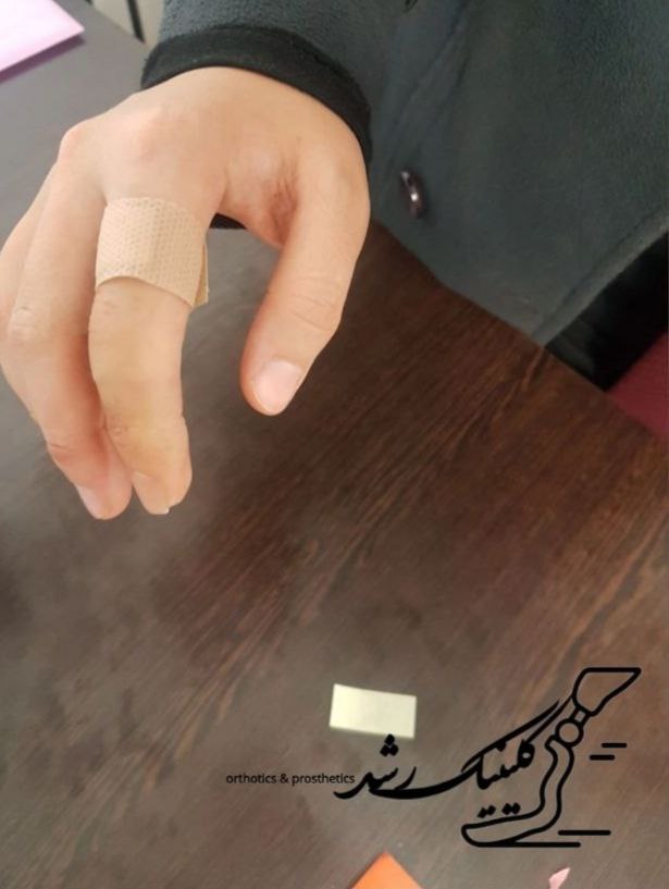 نحوه فیکس شدن پروتز انگشت دست سیلیکونی روی انگشت