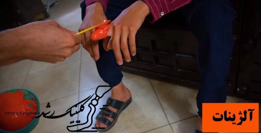 قالبگیری اولیه پروتز انگشت دست با آلژینات پزشکی
