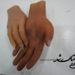 پروتز دست سیلیکونی زیبایی
