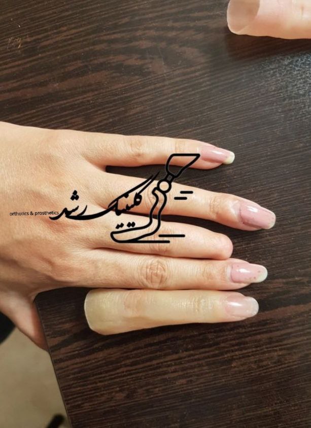 نمونه کار پروتز انگشت دست سیلیکونی با تطابق رنگ پوست