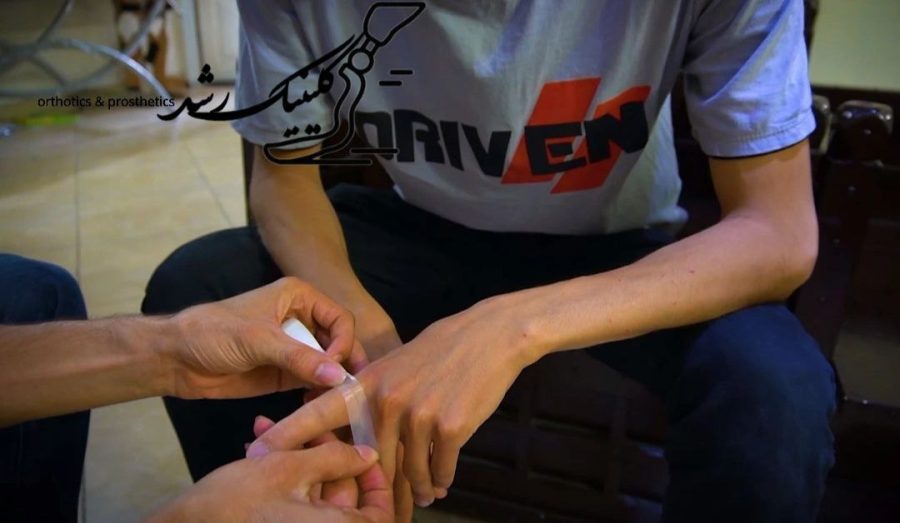 تثبیت محل اتصال پروتز انگشت دست با استفاده از چسب تخصصی