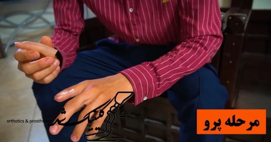 تست اولیه پروتز انگشت دست روی دست مراجعهکننده برای بررسی فیکس و اندازه