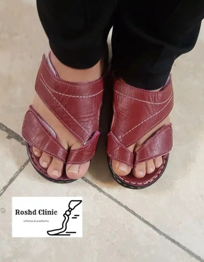 پروتز سفارشی انگشت شست پا با ظاهر طبیعی