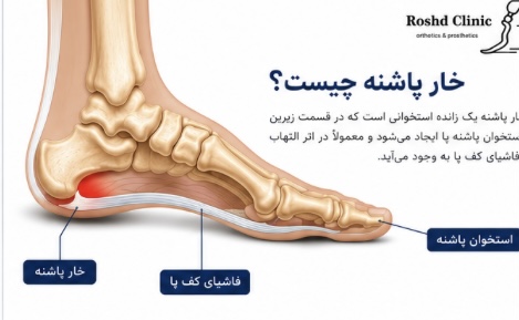 محل ایجاد خار پاشنه در استخوان پاشنه پا