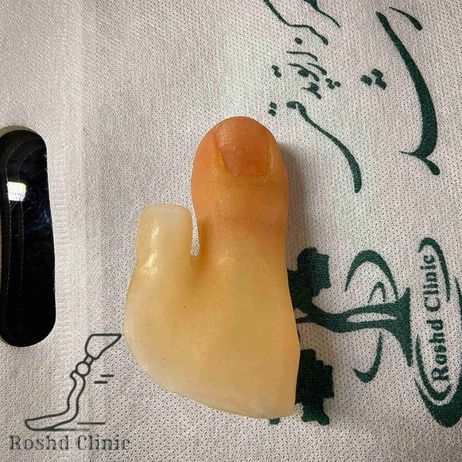 پروتز انگشت پا سفارشی