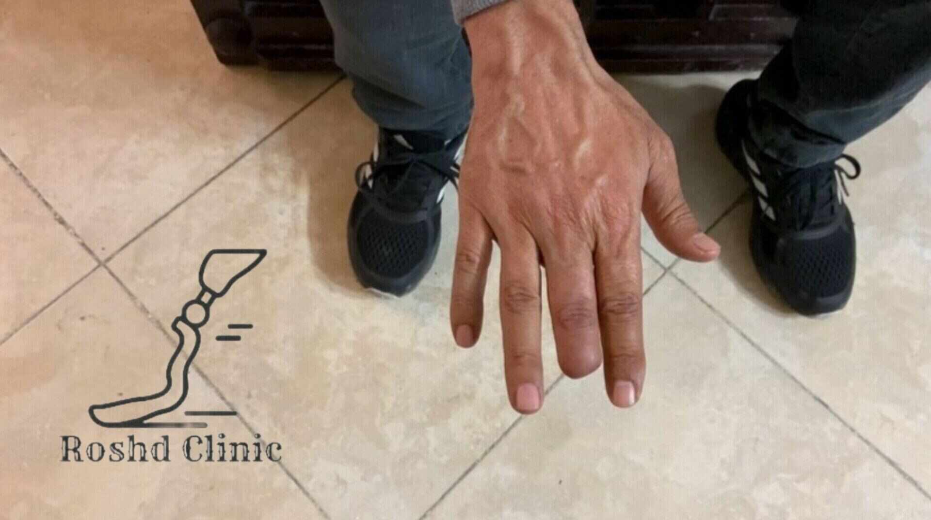 آسیب انگشت بر اثر حمله سگ