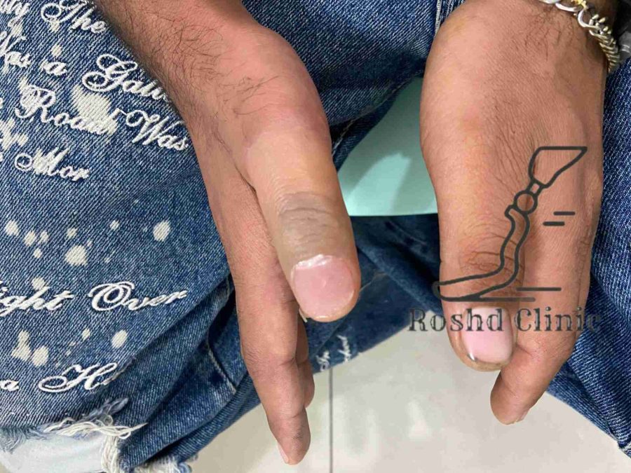 پروتز انگشت شست دست با ظاهر طبیعی
