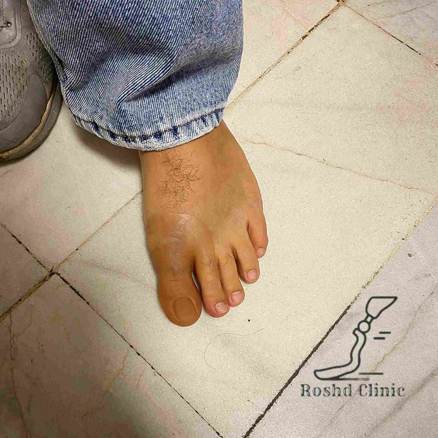 نمای نزدیک پروتز انگشت پا