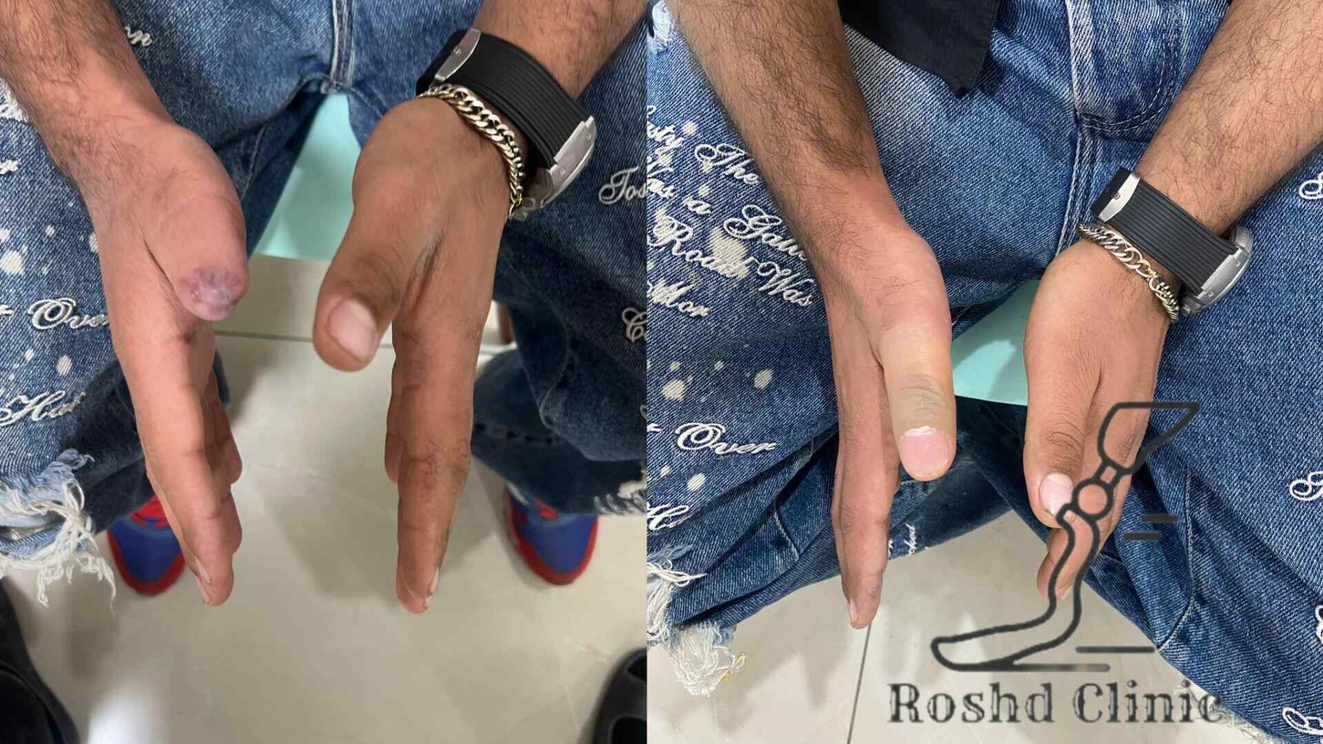 قبل و بعد پروتز انگشت شست دست