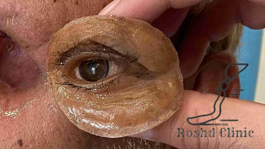 نتیجه نهایی پروتز چشم روی چشم