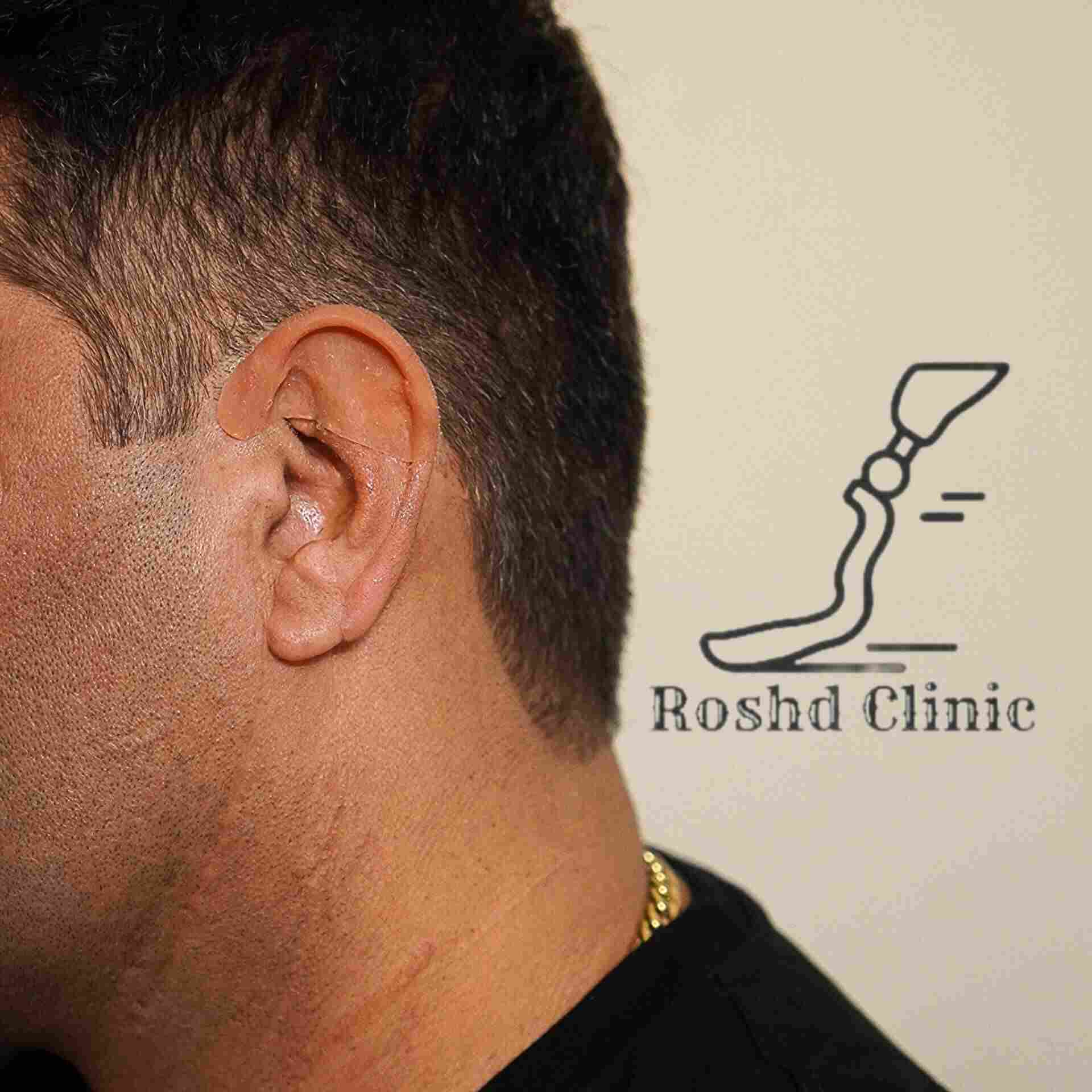 نتیجه نهایی پروتز گوش