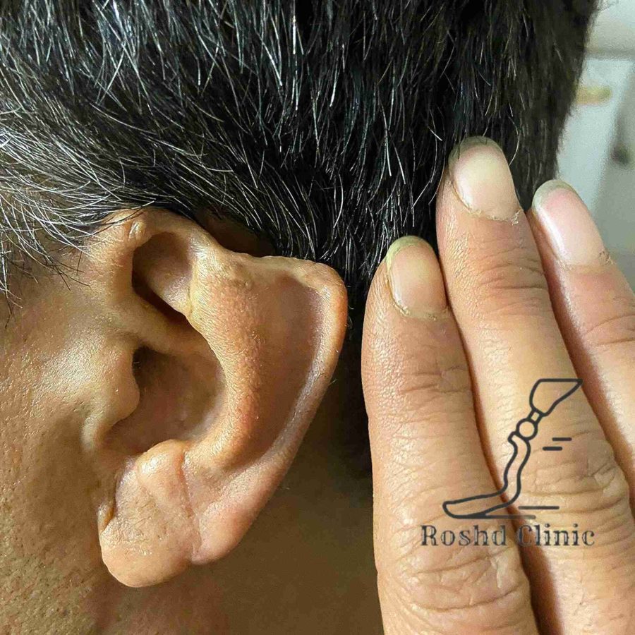 وضعیت اولیه گوش پیش از پروتز