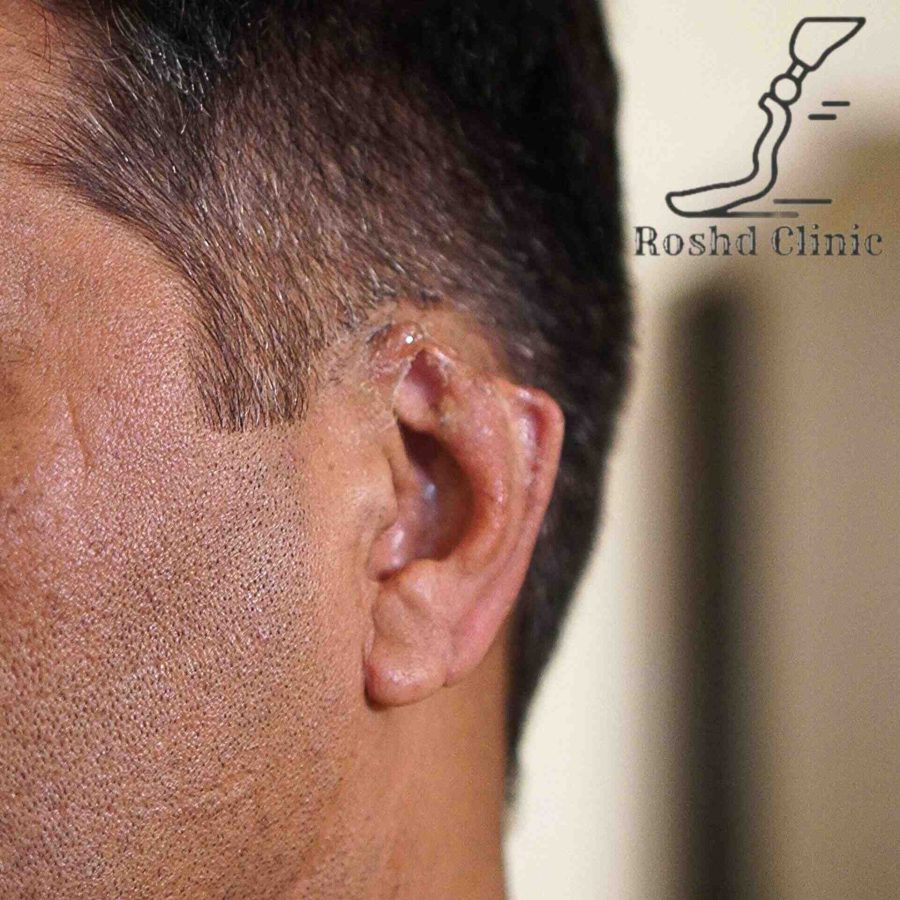 نمای گوش پیش از استفاده از پروتز