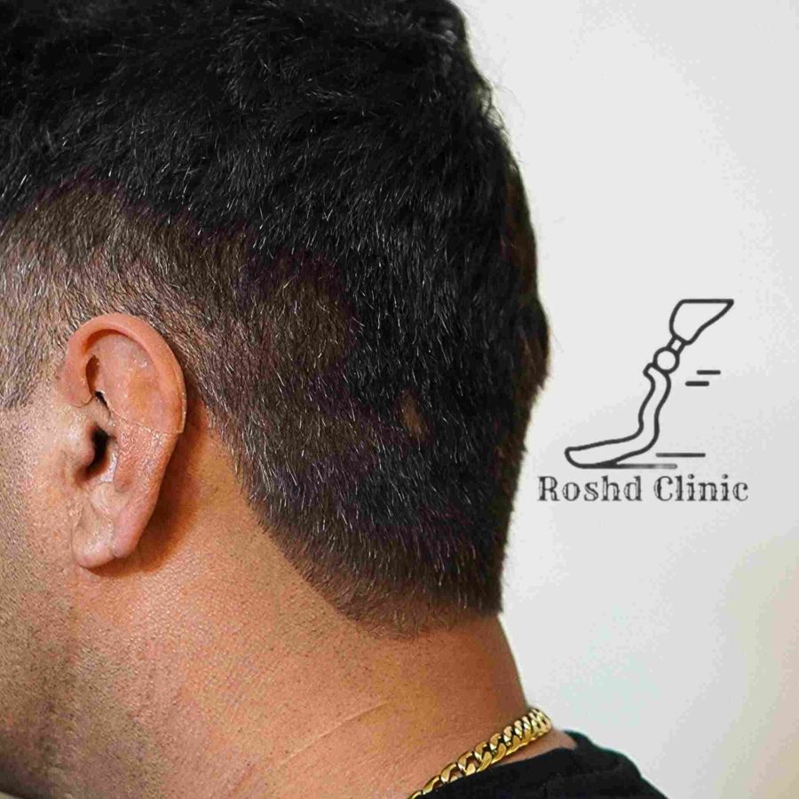 نمای نزدیک پروتز گوش