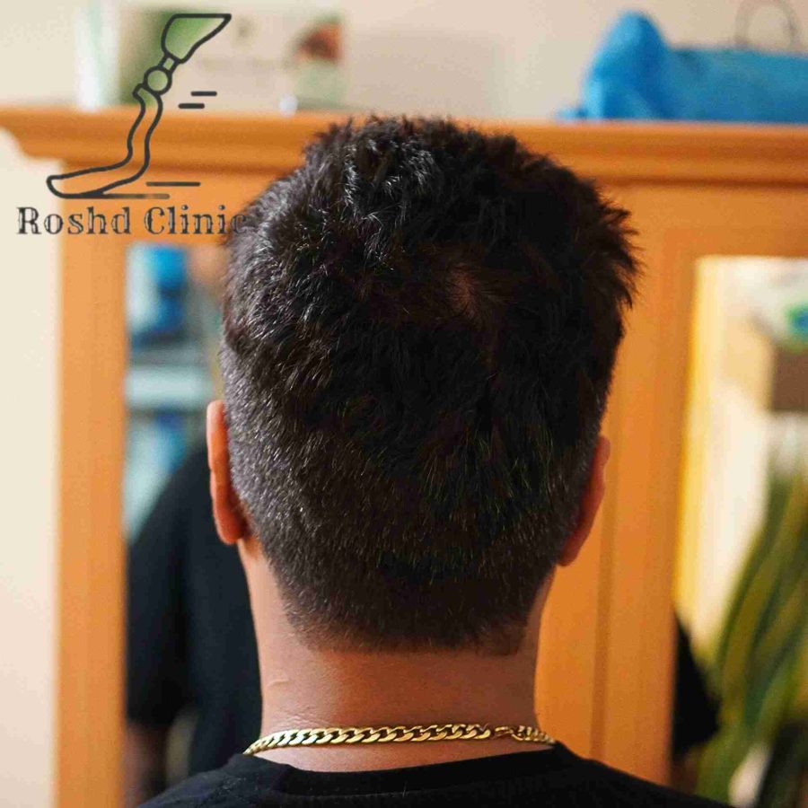 نتیجه نهایی استفاده از پروتز گوش