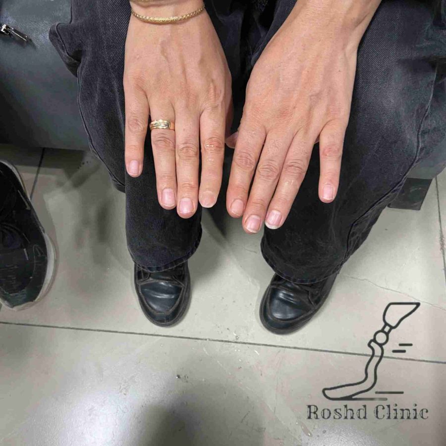 نتیجه نهایی پروتز انگشت