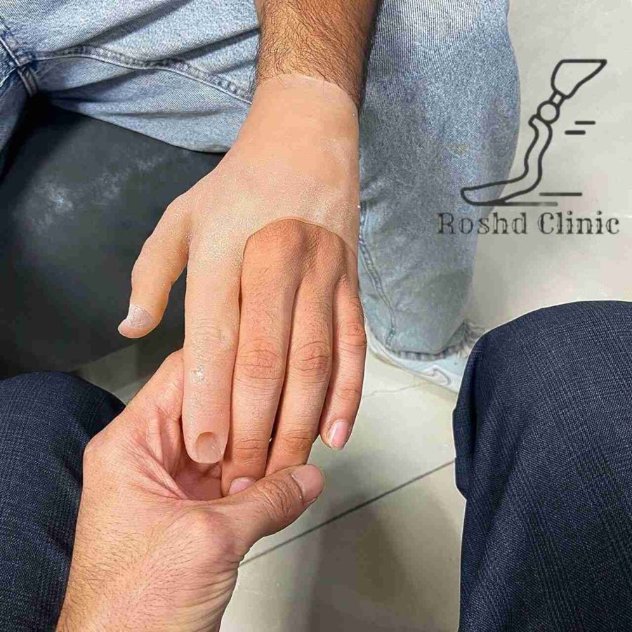 پروتز انگشت قبل از ناخن‌گذاری