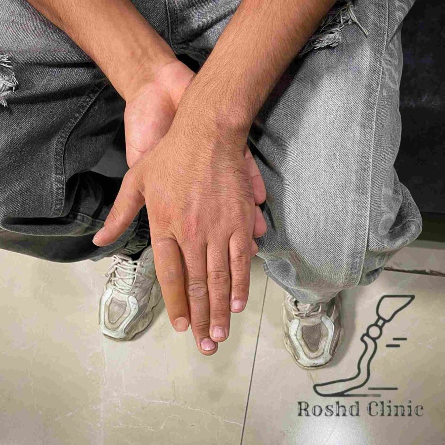 پروتز انگشت روی دست