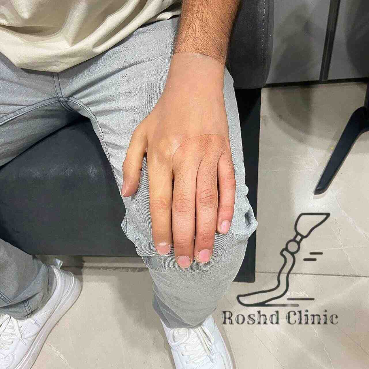 نتیجه پروتز انگشت پس از پوشیدن