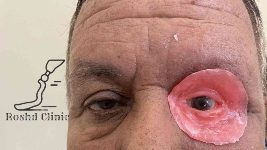 طراحی مومی پروتز چشم